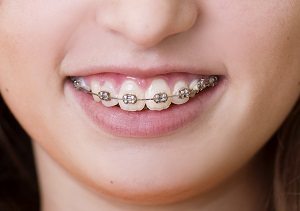 Choosing color for braces