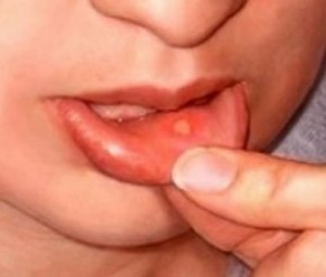 canker sores, pediatric canker sore, pediatric dentist, pediatric dentist san diego, kid's dentist san diego