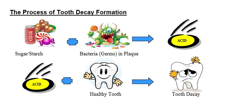 Tooth decay in children - info