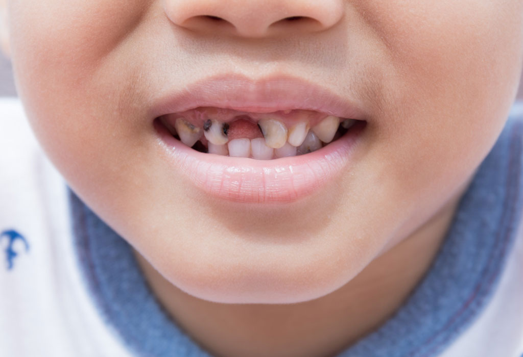 Fighting Tooth Decay in Children - | Best Dental Care for Kids