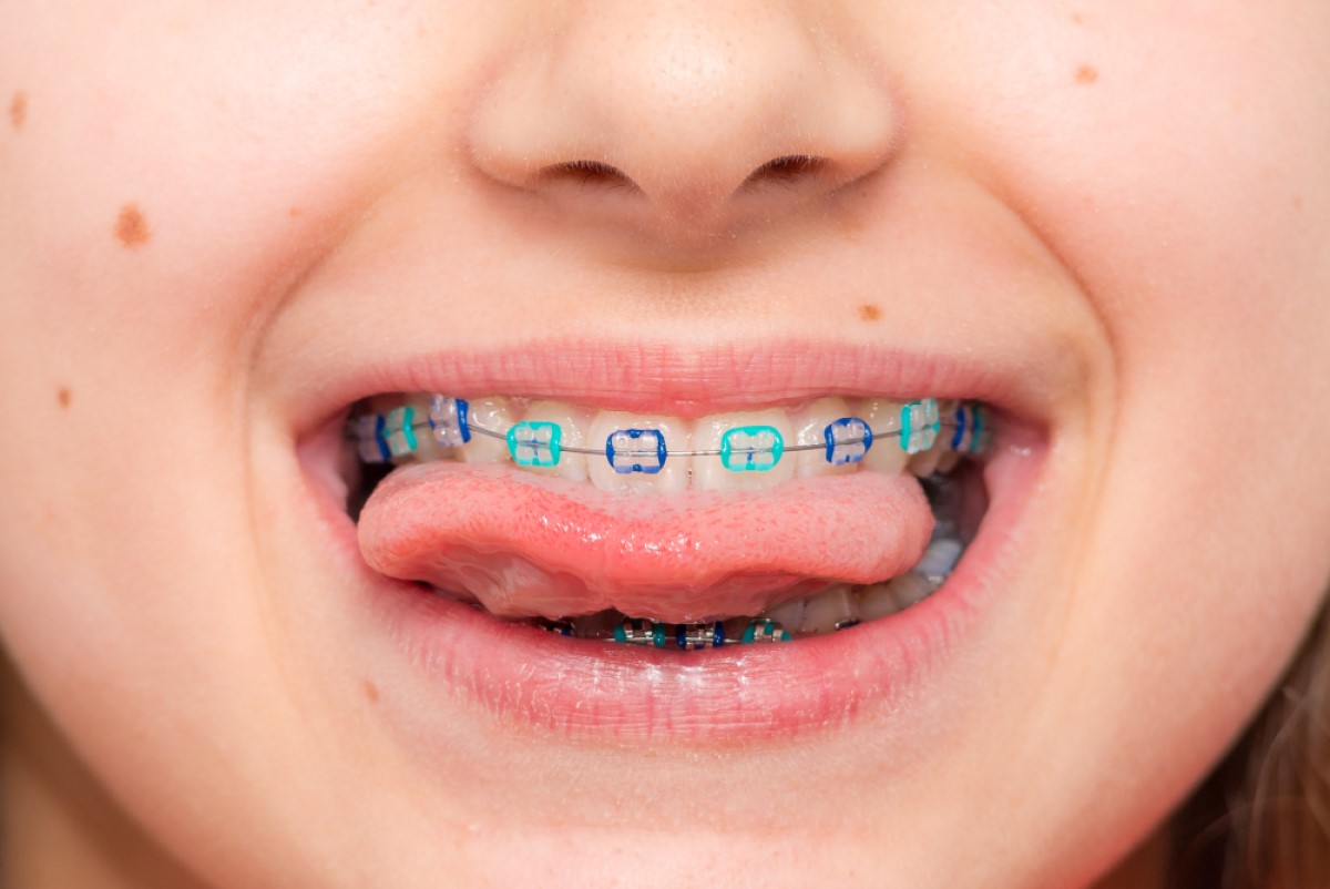 childrens braces