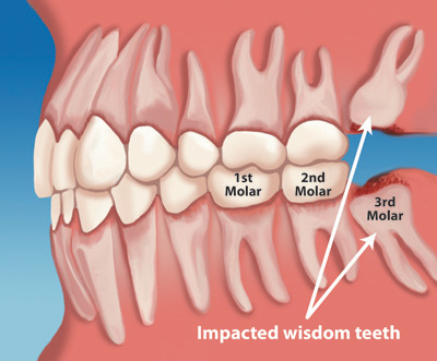 Wisdom Teeth Removal - impacted teeth