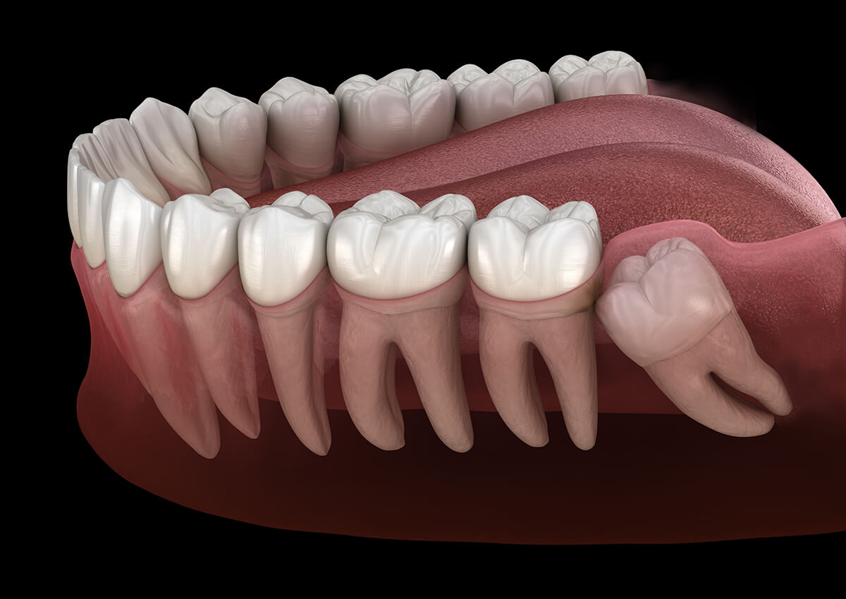 wisdom teeth before and after